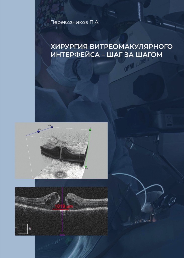 Перевозчиков П.А. Хирургия витреомакулярного интерфейса – шаг за шагом