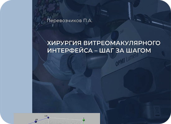Перевозчиков П.А. Хирургия витреомакулярного интерфейса – шаг за шагом